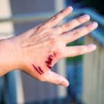 Florida dog bite lawyer