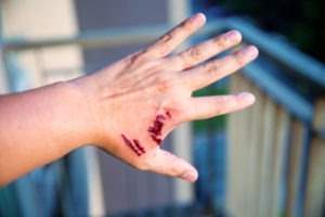 Abogado de mordedura de perro de Florida