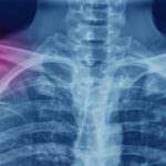 Locations florida truck accident lawyer internal injuries