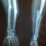 During delivery, infants sometimes suffer broken bones and fractures as their skin and bones are very frail.