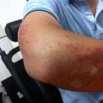 A hematoma is an accumulation of blood surrounding a blood vessel that takes place when the wall of a blood vessel is harmed, and blood is permitted to seep into the tissues.