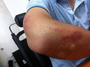 Abogado de lesiones de nacimiento por hematomas de Fort Lauderdale
