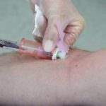 Prolapsed umbilical cord is a problem that occurs before or at the time of delivery of the baby.