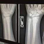 Broken bones are some of the most common personal injuries that occur in accidents.