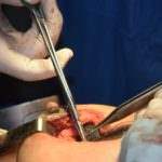 Retained foreign objects, also referred to as the unintended retention of foreign objects (URFOs) or retained surgical items (RSIs), are any items or foreign objects that are left inside the patient after surgery.
