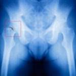 Miami fl slip and fall accident lawyer broken hips or pelvis